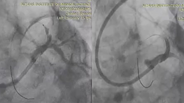 Facing left main PCI in your daily practice: learn from challenging situations