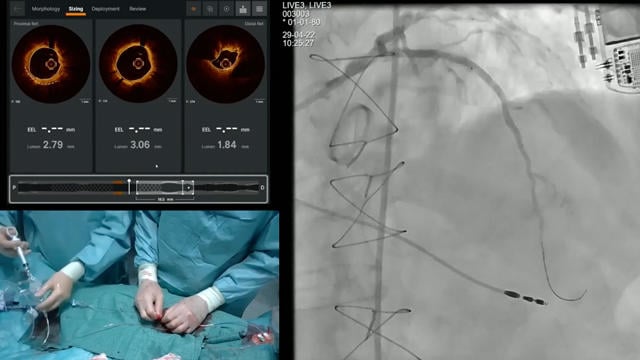 How to deal with calcified lesions