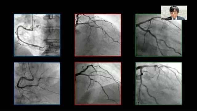 How to select three-vessel disease patients eligible for PCI and guide the treatment by angiography-derived physiology