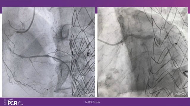 How should I treat STEMI?