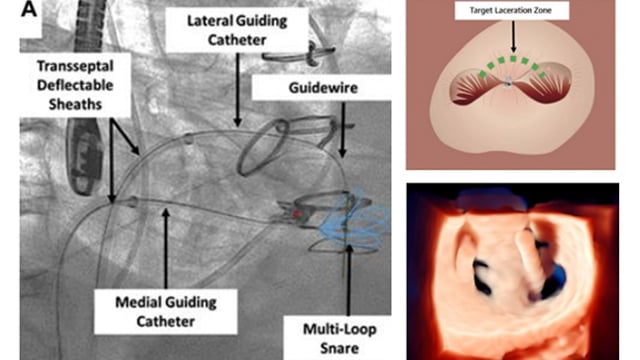 How to deal with residual or recurrent mitral regurgitation after failed surgical or transcatheter repair