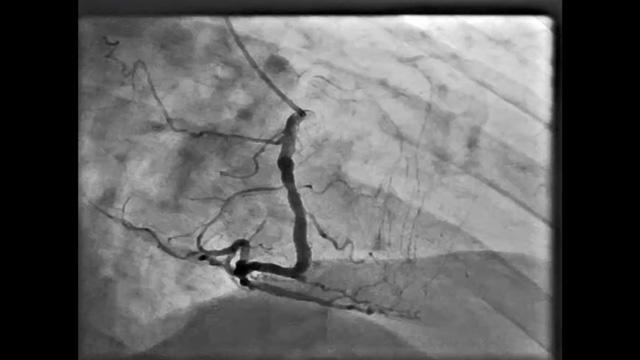 How should I treat complex left main: trifurcation, in-stent restenosis