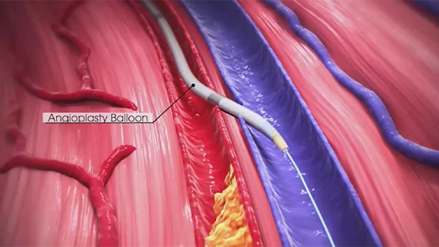 Innovative approaches to complex peripheral interventions