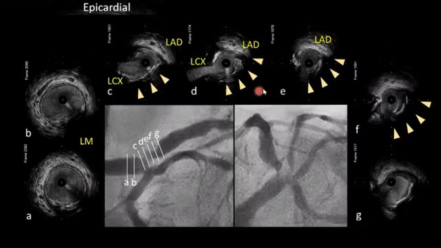 Innovative solutions in complex coronary lesions