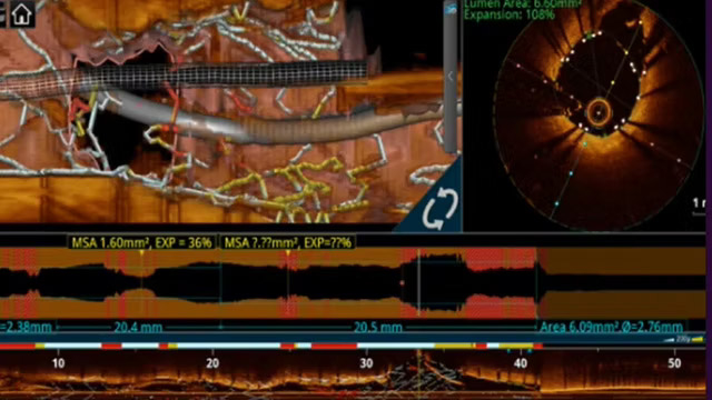 Innovative solutions in complex coronary lesions