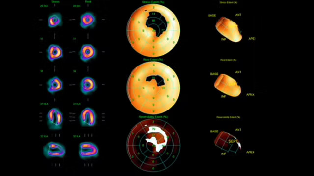 Innovative solutions in complex coronary lesions