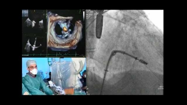 Leading clinical evidence while disrupting the mitral paradigm with clip therapy