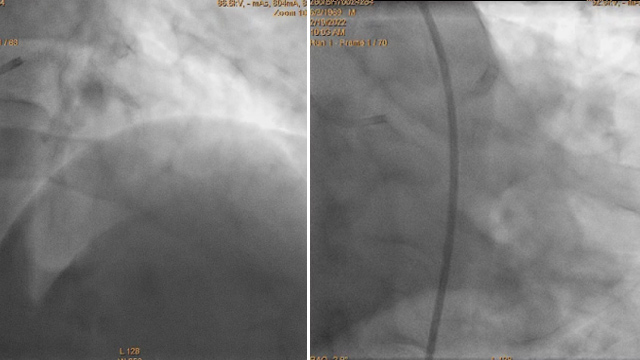 Left main and multivessel disease - Session 1