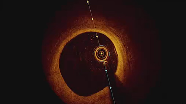 Major role of intracoronary imaging in primary PCI
