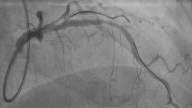 Managing complications during PCI for NSTEMI