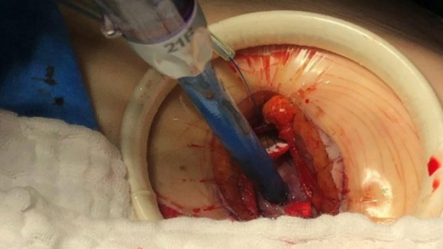 Mitral annular calcification - From diagnosis to treatment