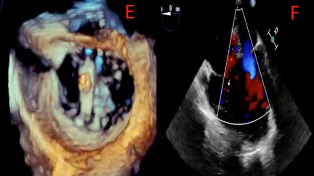 Mitral complications