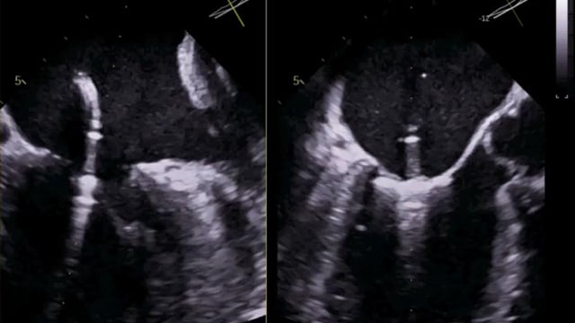 Mitral edge-to-edge repair: surgical and transcatheter approaches