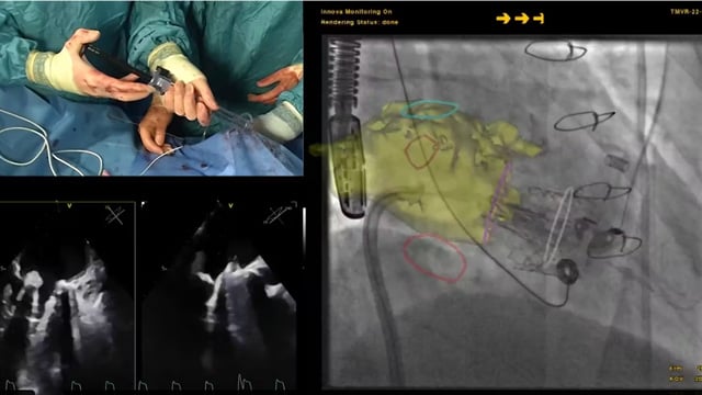 Recorded case: Mitral valve in MAC