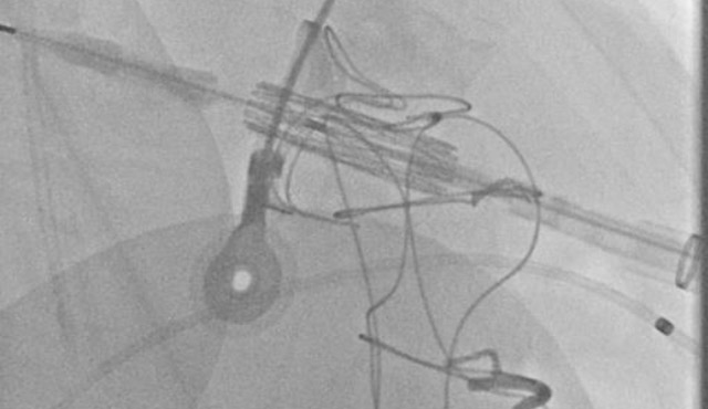Mitral valve-in-valve interventions