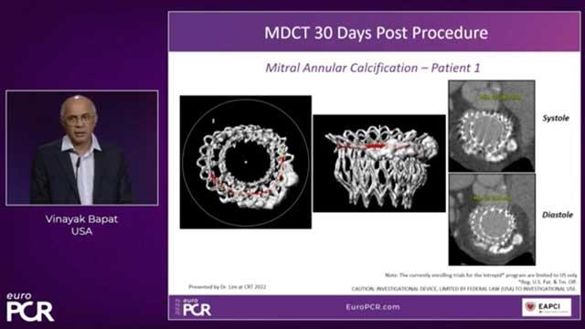 A new focus on mitral and tricuspid valve disease