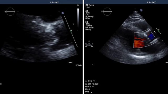 Patient-prosthesis mismatch: surgical and transcatheter approaches