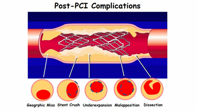 PCI in complex high-risk patients: acute coronary syndrome and multivessel disease PCI