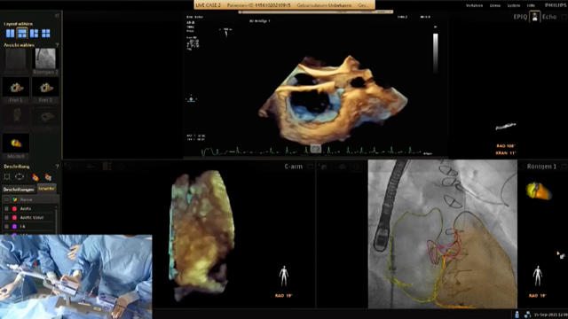 PCR Tricuspid Focus Group update: present and future of tricuspid regurgitation treatment