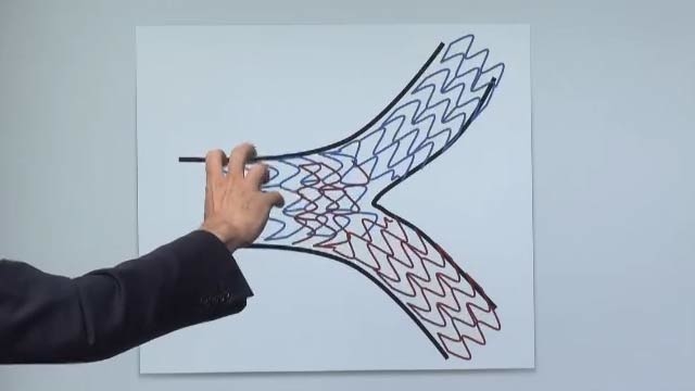 Pearls and pitfalls of Culotte stenting