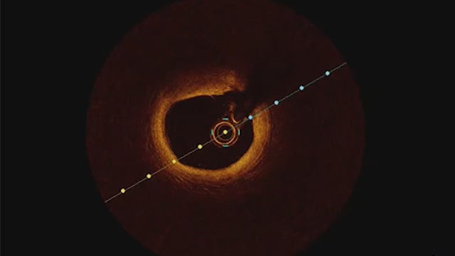 Peculiar causes of STEMI