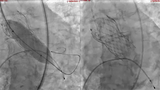 Predicting and managing TAVI conduction related disorders