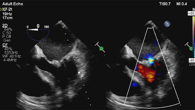 Prevention and treatment of complications related to valve interventions