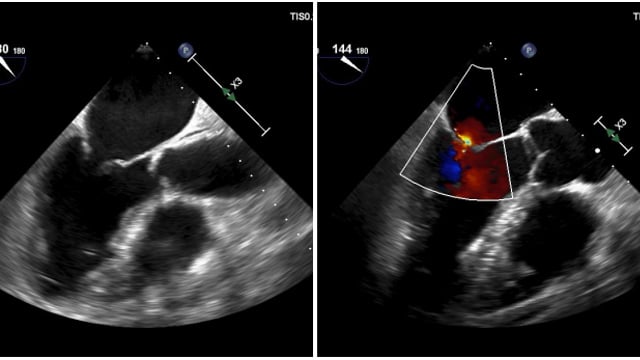 Primary mitral regurgitation: key imaging requirements for diagnosis and procedural planning