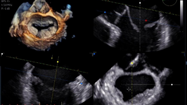 Primary mitral regurgitation: treatment options when the anatomy is complex