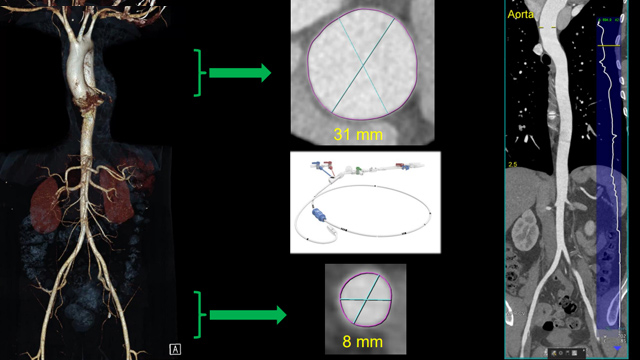 Primary mitral regurgitation: treatment options when the anatomy is simple