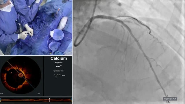 Role of OCT in multivessel PCI