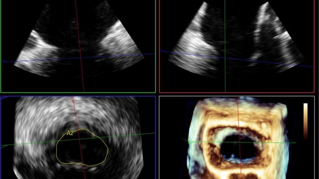 Secondary mitral regurgitation: challenges in management