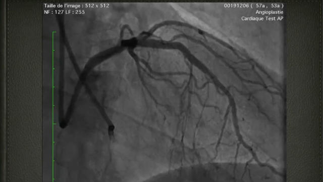 Selecting CTO strategies - Quo vadis based on angiograms