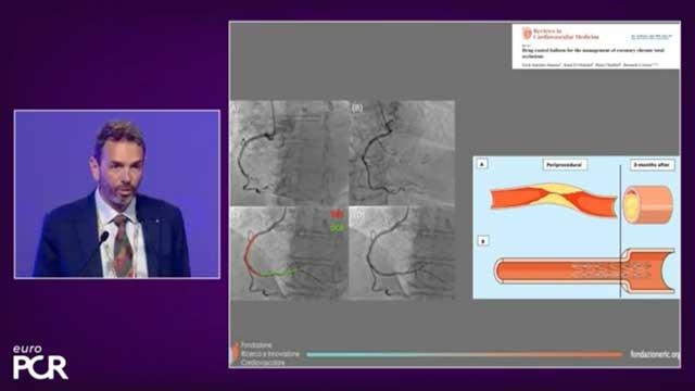 Sirolimus coated balloon and coronary artery disease: expanding the treatment indications