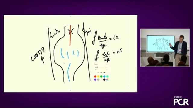 Start treating refractory angina patients with Reducer therapy - Practical aspects