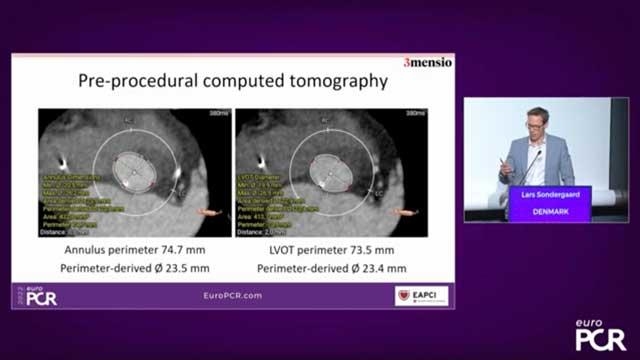 State-of-the-art imaging for structural heart disease interventions