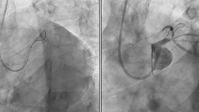 STEMI - Adjunctive pharmacotherapy