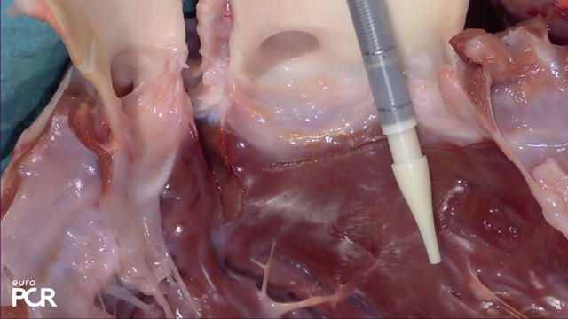 TAVI best practice: implementing cusp overlap and commissural alignment