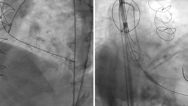 TAVI complications: Session 3