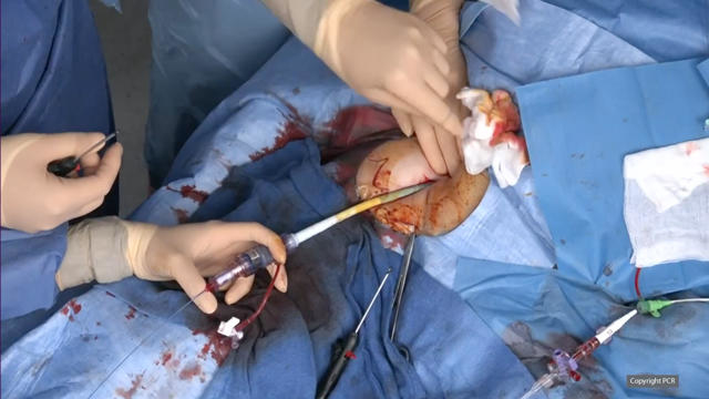 TAVI in a patient with bicuspid anatomy
