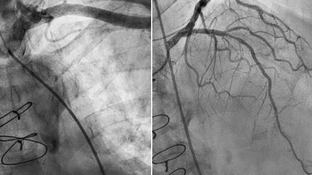 TAVI in patients at risk of coronary occlusion