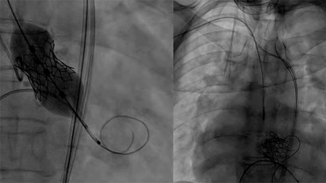 TAVI in severe calcified anatomy