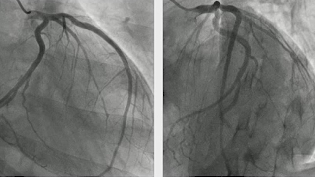 TAVI indications in complex situations