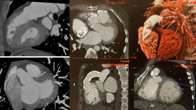 The right valves for the right ventricle: Venus MedTech tricuspid and pulmonary replacement systems