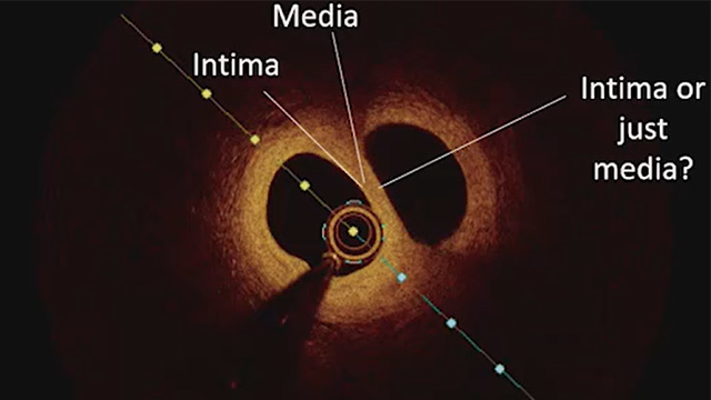 The yield of intra-coronary assessment in NSTEMI