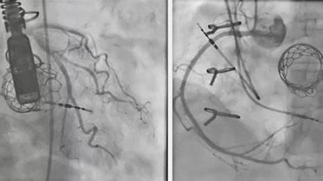 Transcatheter mitral valve implantation in challenging anatomies
