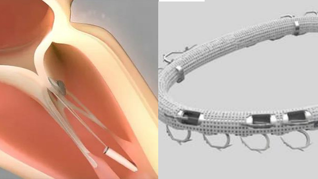 Transcatheter mitral valve intervention is progressing more slowly than expected: why is it happening? And what can we do? Root causes, challenges and opportunities