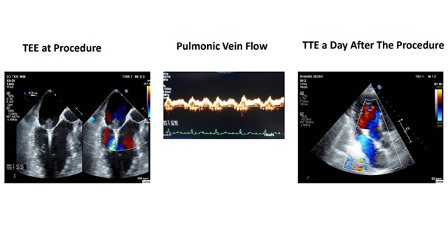 Transcatheter mitral valve interventions: clinical outcomes 1