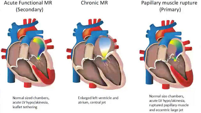 Transcatheter mitral valve interventions: clinical outcomes 2