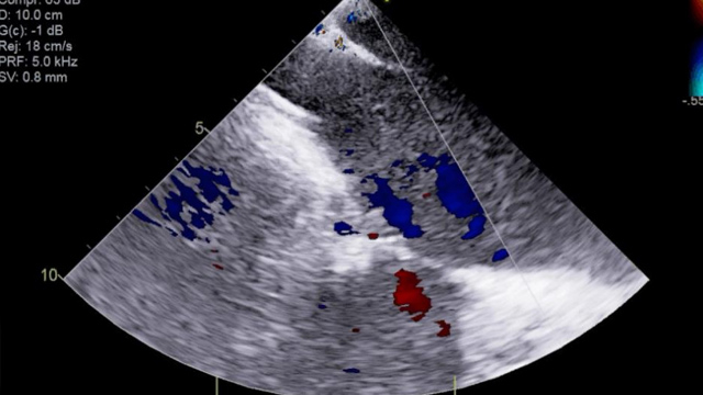 Transcatheter tricuspid valve intervention is booming: where are we now? and where are we going?